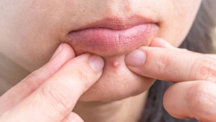 ७ दिवसात कमी होतील चेहऱ्यावर वाढलेले पिंपल्स आणि काळे डाग! कडुलिंबाच्या पानांचा ‘या’ पद्धतीने करा वापर, त्वचा होईल स्वच्छ