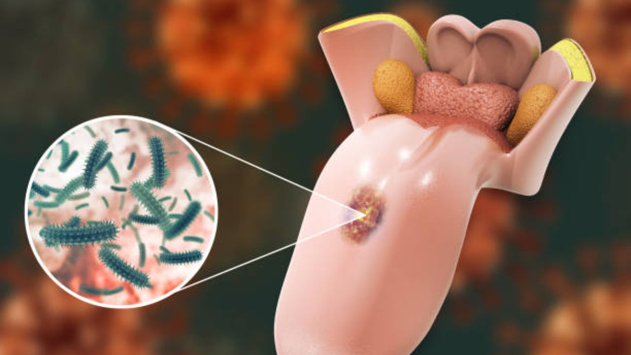 World Cancer Day 2026:  ओरल कॅन्सरचे उशीरा निदान झाल्यामुळे उद्भवतात गंभीर समस्या, देशात जवळपास ७०-८० टक्‍के रुग्ण