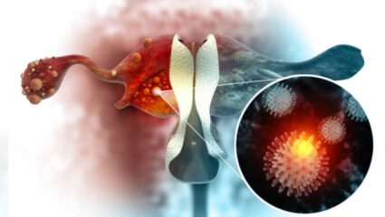 Ovarian cancer संबंधित गैरसमजुती आजच करा दूर! जाणून घ्या तज्ज्ञांनी सांगितलेली सविस्तर माहिती