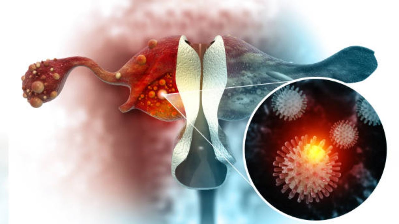 Ovarian cancer संबंधित गैरसमजुती आजच करा दूर! जाणून घ्या तज्ज्ञांनी सांगितलेली सविस्तर माहिती