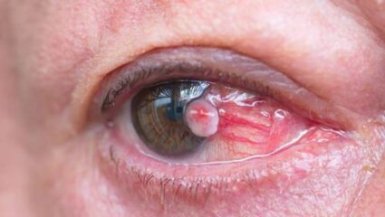 World Cancer Day 2026: डोळ्यांच्या कॅन्सरची लागण झाल्यानंतर दिसून येतात ‘ही’ महाभयंकर लक्षणे, दुर्लक्ष केल्यास गमवावी लागेल दृष्टी