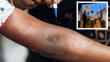 Dharashiv News : कुष्ठरोग नियंत्रणात राज्यात पहिला क्रमांक; धाराशिवची उल्लेखनीय कामगिरी