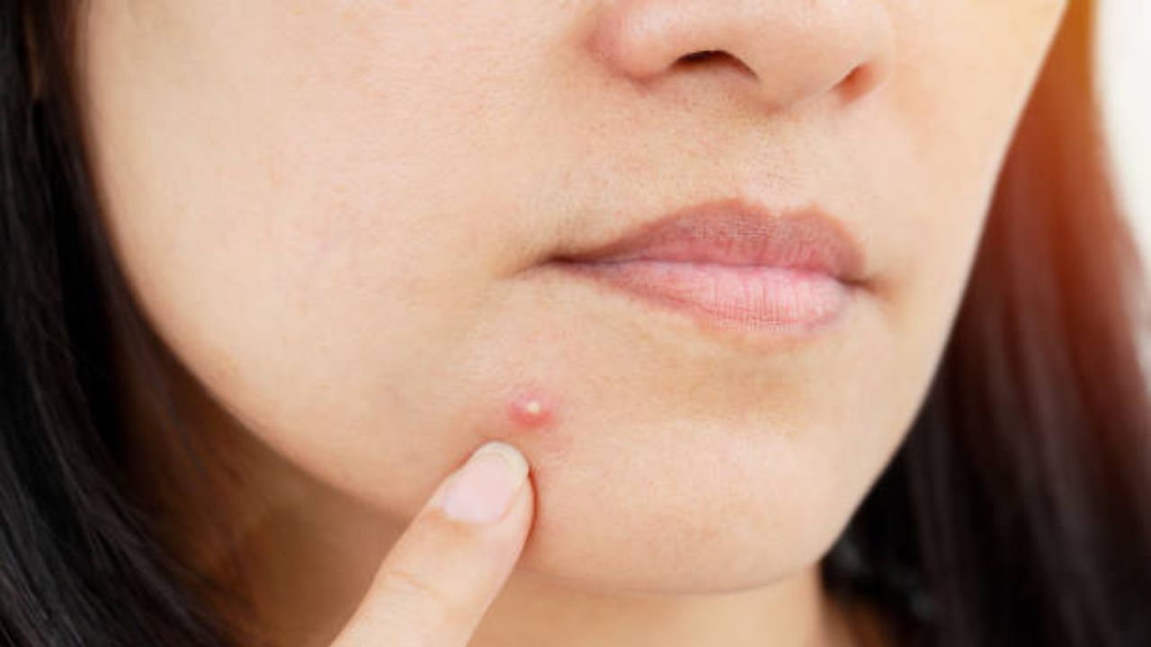 महागड्या क्रीमची गरज नाही फक्त हे एक काम करा आणि 5 रुपयांत पिंपल्सना करा रामराम