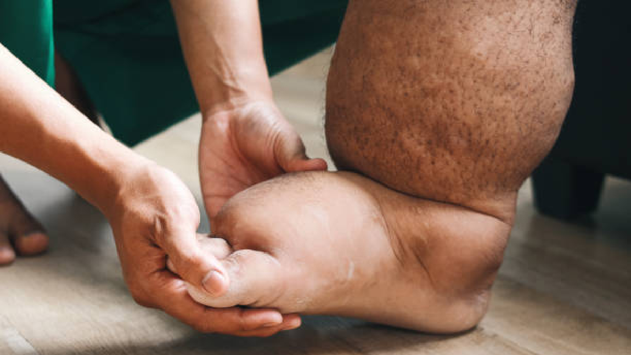 हत्तीरोग निर्मूलनासाठी ‘ट्रिपल ड्रग थेरपी’ मोहिमेला वेग; CM Devendra Fadnavis यांनी काय सांगितले?