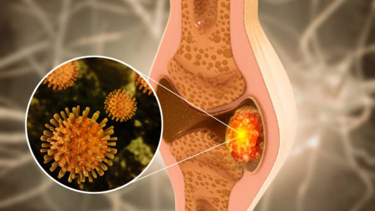 हाडांमध्ये वाढलेल्या सामान्य वेदना असू शकतात Bone Cancer चे संकेत, दुर्लक्ष केल्यास कोणत्याही क्षणी होईल मृत्यू