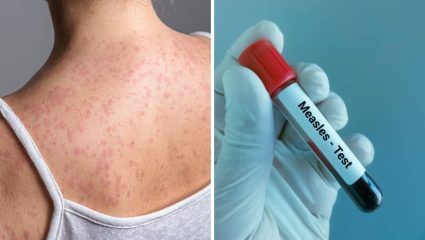 मुंबईमध्ये गोवर रुग्णांच्या संख्येत झपाट्याने वाढ! धारावी, गोवंडी हॉटस्पॉट; लसीकरणाकडे करू नका दुर्लक्ष