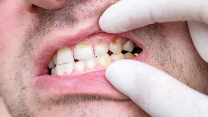 दातांवर वाढलेल्या पिवळेपणामुळे हसताना लाजिरवण्यासारखे वाटते? पांढऱ्या शुभ्र दातांसाठी करा ‘हे’ घरगुती उपाय