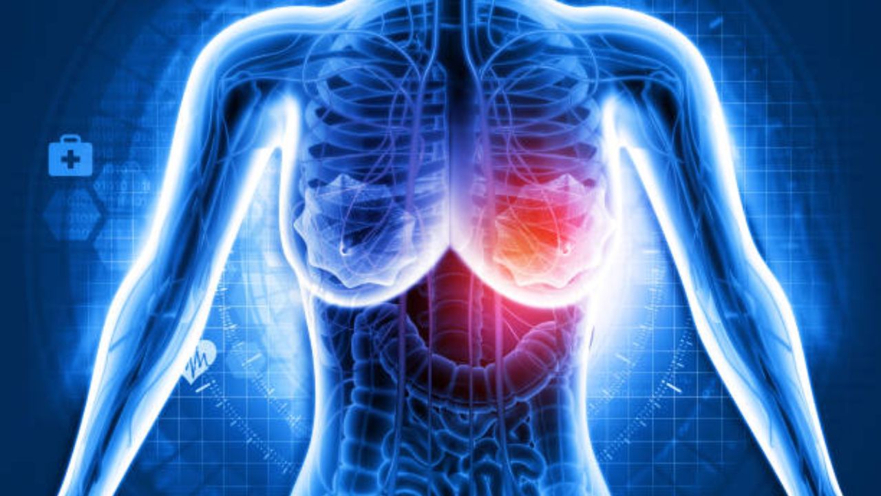 Early Breast Cancer: स्‍तनाच्‍या कर्करोगाच्‍या सुरुवातीच्या काळात जवळच्या माणसांचा पाठिंबा गरजेचा, काय सांगतात तज्ज्ञ