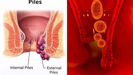 मूळव्याध होईल मुळांपासून नष्ट! आतडे स्वच्छ करण्यासाठी नियमित खा ‘हे’ फायबरयुक्त पदार्थ, बद्धकोष्ठता होईल दूर
