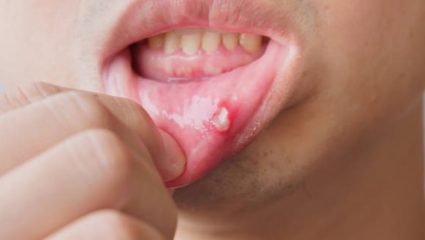 Mouth Ulcer: तोंडात झालेल्या जखमांमुळे खाणे पिणे कठीण झाले आहे? मग अल्सर बरे करण्यासाठी करा ‘हे’ घरगुती उपाय
