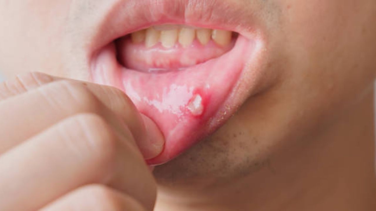 Mouth Ulcer: तोंडात आलेल्या जखमांमुळे खाणे पिणे कठीण झाले आहे? मग अल्सर बरे करण्यासाठी करा ‘हे’ घरगुती उपाय