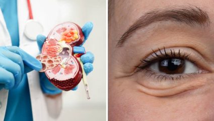 सकाळी उठल्यानंतर चेहरा टम्म सुजल्यासारखा वाटतो? किडनीच्या आजाराची लागण झाल्यानंतर दिसून येतात ‘ही’ गंभीर लक्षणे