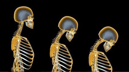 ‘Osteoporosis’ एक सामान्य पण अनेकदा दुर्लक्षित राहणारा आजार! काय म्हणतात डॉ. मनीष सोनटक्के?