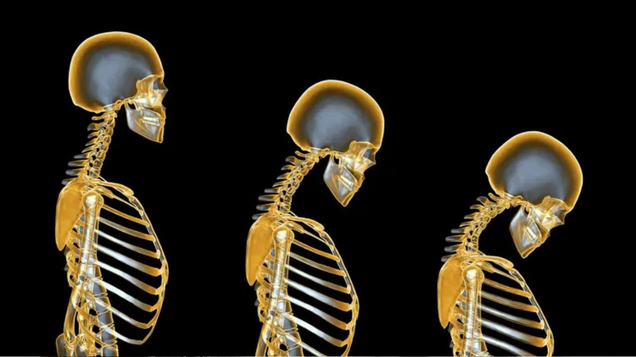 ‘Osteoporosis’ एक सामान्य पण अनेकदा दुर्लक्षित राहणारा आजार! काय म्हणतात डॉ. मनीष सोनटक्के?