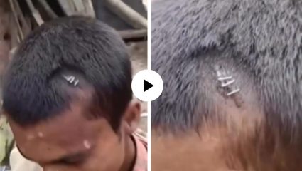अरे बापरे! डोकं फुटलं तर डॉक्टरांनी टाक्यांच्या ऐवजी जखमेवर लावली स्टेपलर पिन; धक्कादायक घटनेचा Video Viral