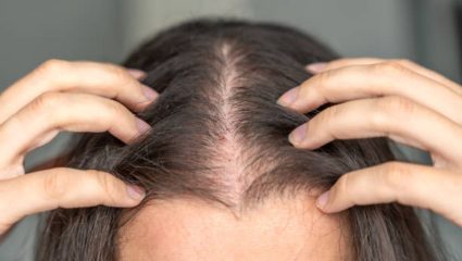 अचानक मोठ्या प्रमाणावर केस गळती वाढली आहे? आरोग्यासंबंधित असू शकतात ‘या’ गंभीर आजाराचे संकेत