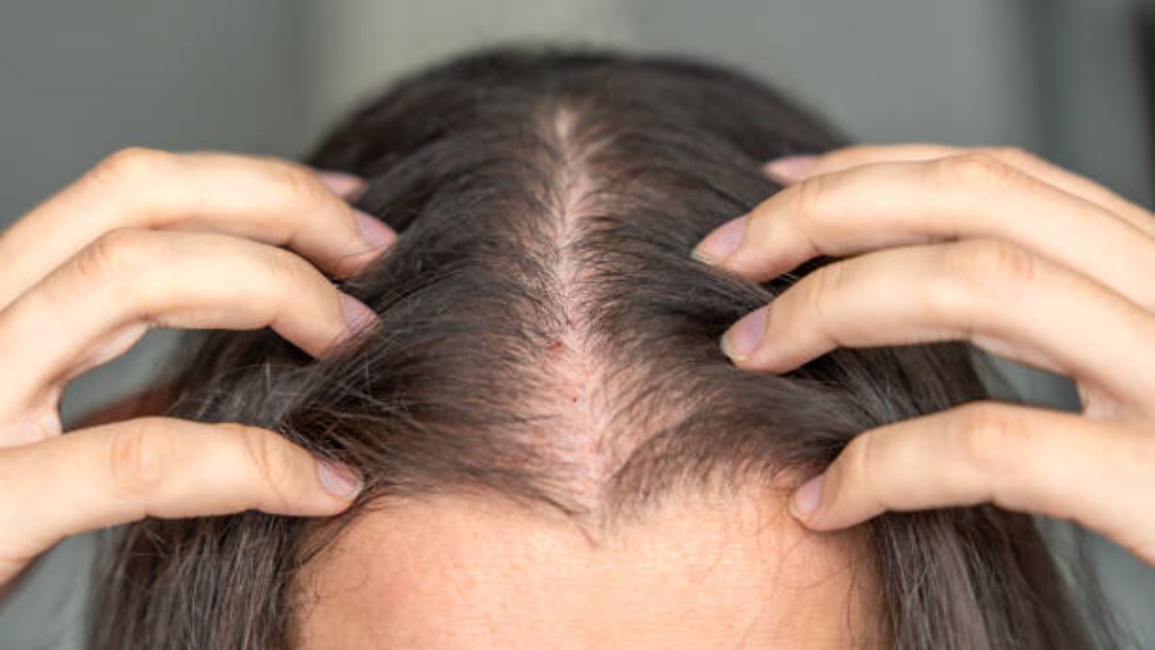 अचानक मोठ्या प्रमाणावर केस गळती वाढली आहे? आरोग्यासंबंधित असू शकतात ‘या’ गंभीर आजाराचे संकेत