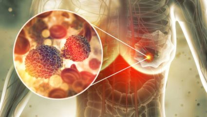 काखेत कायमच वेदना होतात? ब्रेस्ट कॅन्सरच्या ‘या’ लक्षणांकडे अजिबात करू नका दुर्लक्ष, गंभीर आजार टाळण्यासाठी वेळीच करा उपचार