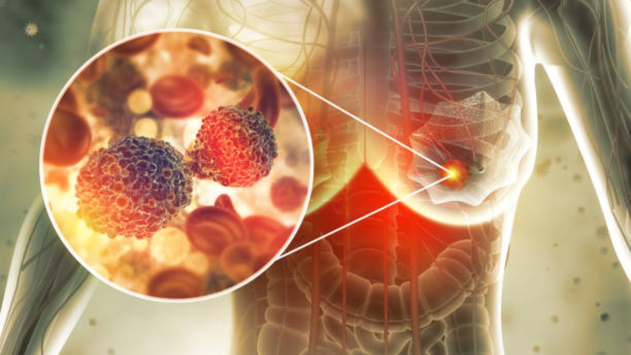 काखेत कायमच वेदना होतात? ब्रेस्ट कॅन्सरच्या ‘या’ लक्षणांकडे अजिबात करू नका दुर्लक्ष, गंभीर आजार टाळण्यासाठी वेळीच करा उपचार