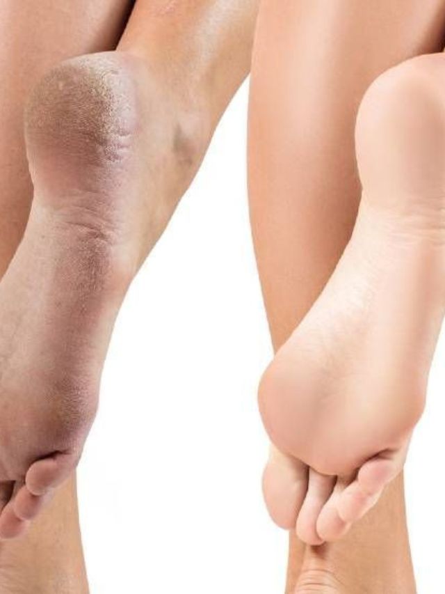 या उपायांमुळे तळवे होतील गुळगुळीत