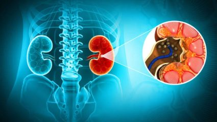 उन्हाळ्यात का वाढतो किडनी स्टोनचा धोका? जाणून घ्या यामागील कारणे आणि स्टोन नष्ट करण्यासाठी घरगुती उपाय