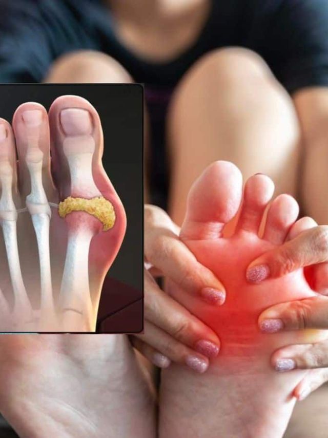 युरिक ऍसिड कमी करण्यासाठी घरगुती उपाय