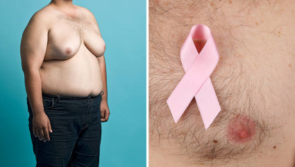 स्तन नसूनही का होतो पुरुषांना कॅन्सर, तज्ज्ञांनी सांगितला वाढता धोका; Breast Cancer Risk पुरुषांमध्ये वाढण्याचे कारण