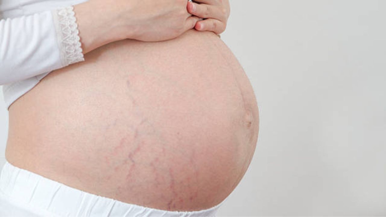 प्रेग्नंसीनंतरच्या स्ट्रेच मार्क्सने हैराण झालात? महागडे प्रोडक्ट्स सोडा, हे घरगुती उपाय करतील तुमची मदत