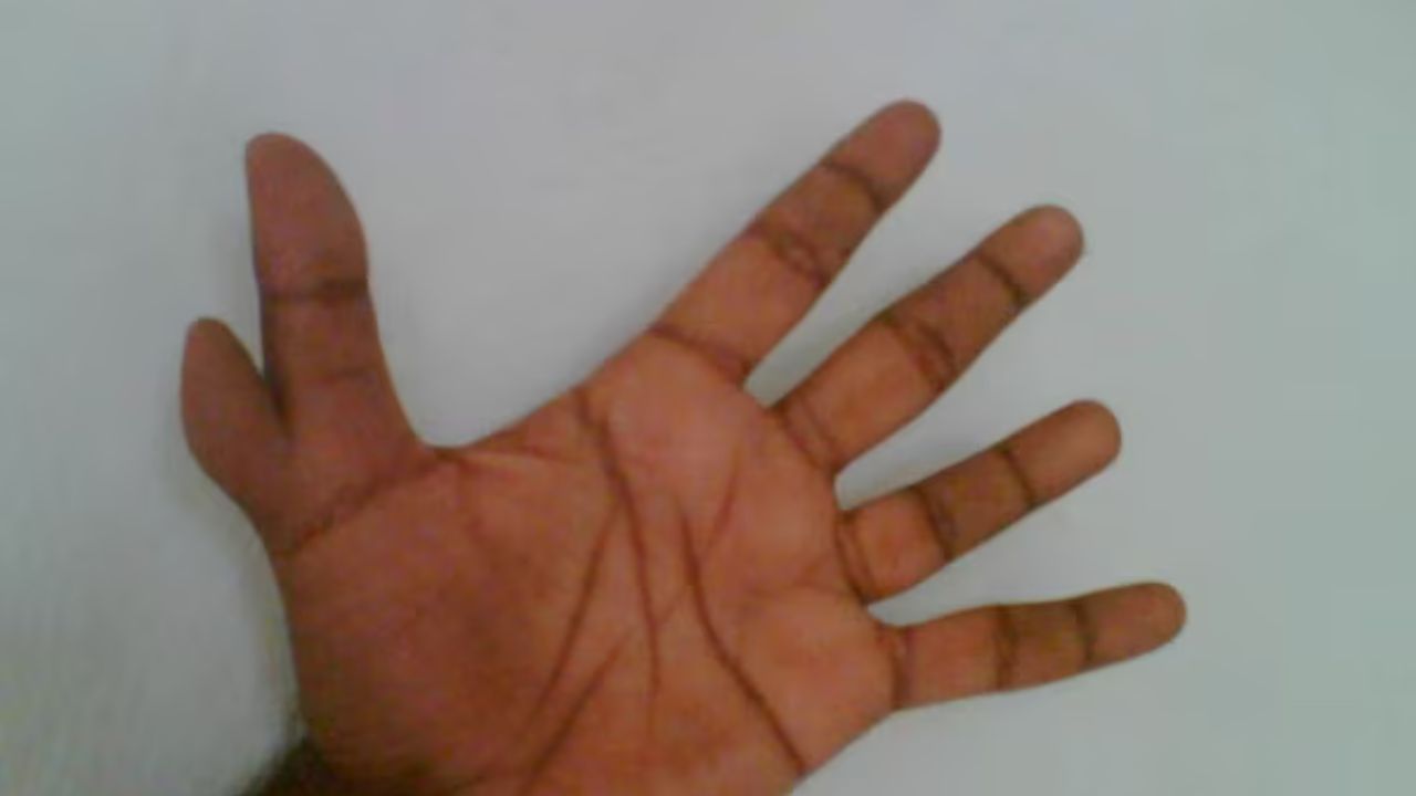 Hast Rekha: हाताला 6 बोटं असणं शुभ की अशुभ ? काय सांगतं हस्तरेखाशास्त्र, जाणून घ्या सविस्तर