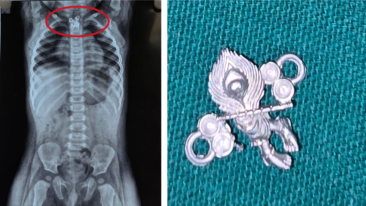 Mumbai Hospital News: सात महिन्यांच्या चिमुकल्याने गिळले ‘कृष्ण’ लॉकेट, डॉक्टरांनी एंडोस्कोपीतून वाचवला जीव