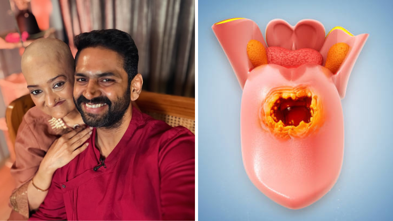 5 वेळा सर्जरी तरीही पुन्हा Oral Cancer परतला, Sharib Hashmi च्या बायकोचा आजार; किती वेळा परत येऊ शकतो कॅन्सर