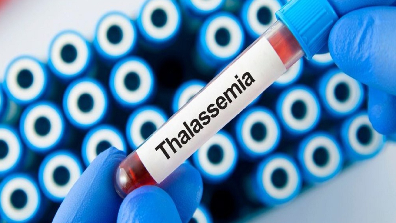 World Thalassemia Day : थॅलेसेमिया हा आजार काय असतो? उपचार कसे केले जातात? तज्ज्ञांनी दिला महत्वाचा सल्ला