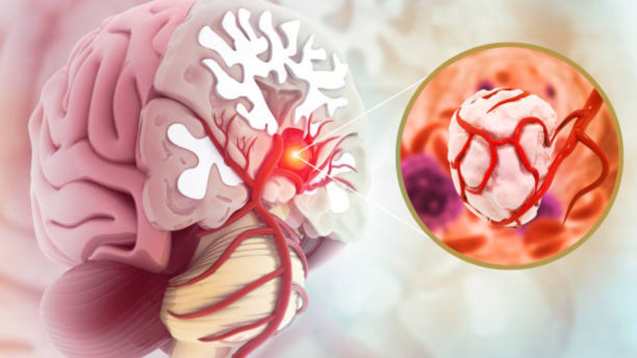 World Brain Tumor Day: ब्रेन ट्युमर रुग्णांना मोठा दिलासा! मेंदूतील गाठींवर होणारा सुरक्षित आणि अचूक उपचार