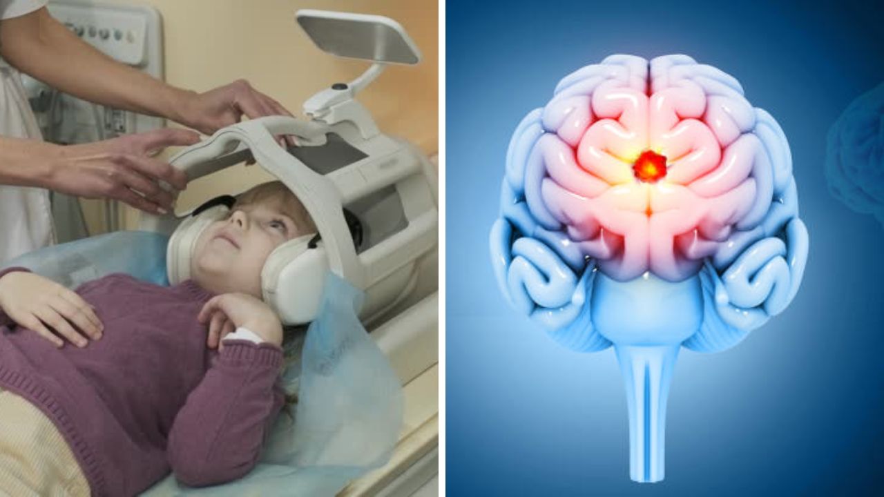 World Brain Tumor Day: मुलांमध्ये सर्वाधिक आढळणारा ब्रेन ट्यूमर कोणता? जाणून घ्या गंभीर आजारांची लक्षणे आणि त्यावरील योग्य उपचार