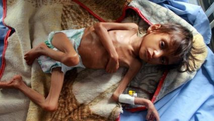 Malnutrition Maharashtra: राज्यात ३ वर्षांत ४० हजार बालमृत्यू ! कुपोषणाचा डाग पुसण्यात सरकार अपयशी?