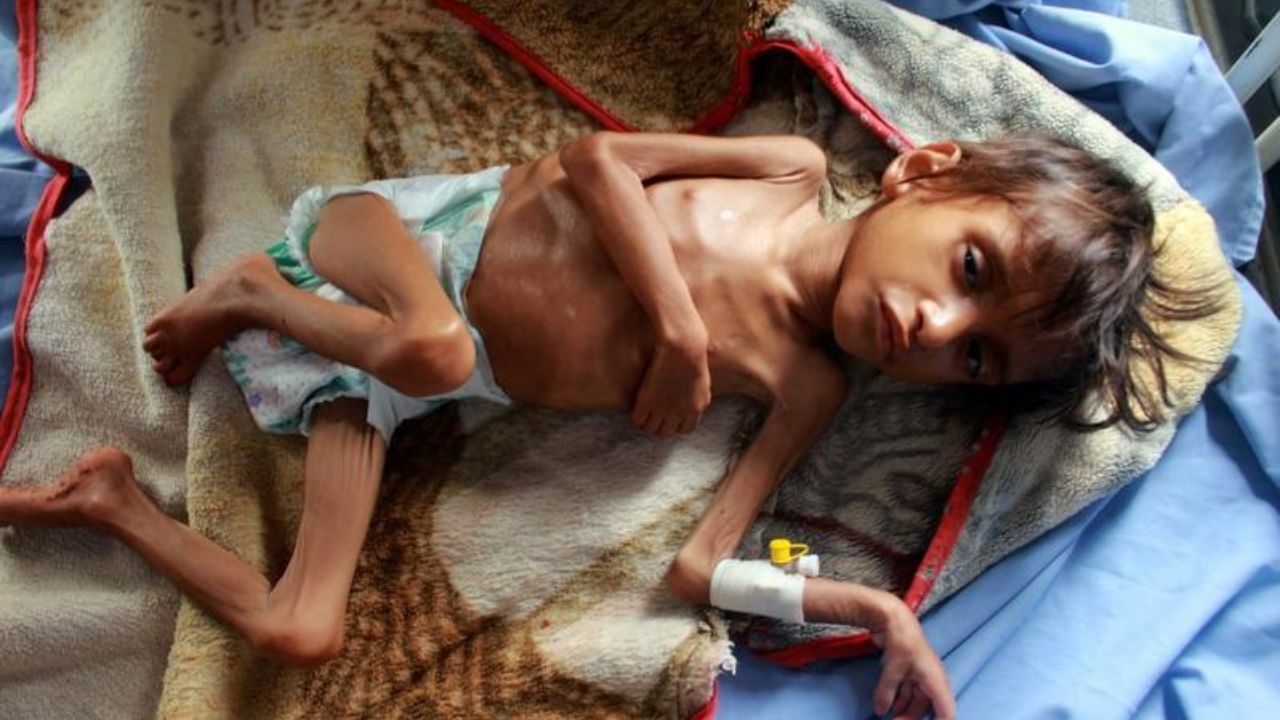 Malnutrition Maharashtra: राज्यात ३ वर्षांत ४० हजार बालमृत्यू ! कुपोषणाचा डाग पुसण्यात सरकार अपयशी?