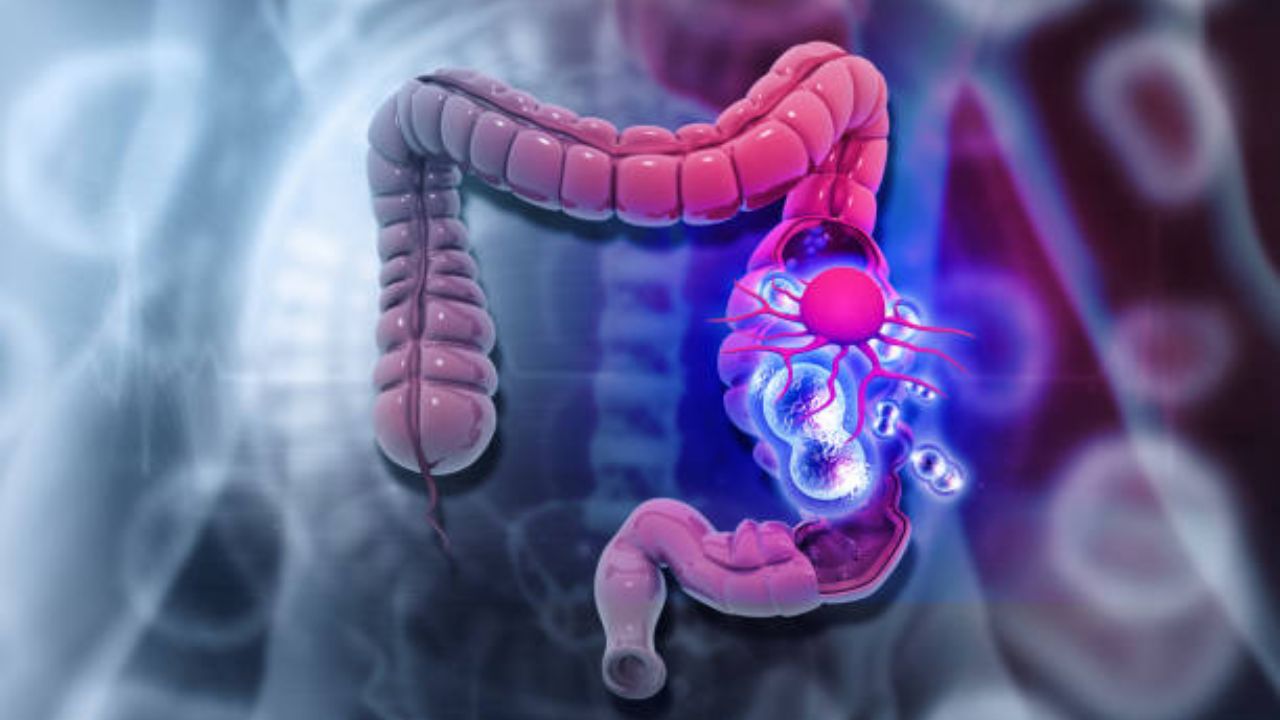 Foods For Colon Cancer: आतड्यांचा कॅन्सर होऊ नये म्हणून आहारात करा ‘या’ पदार्थांचे सेवन, लक्षणे दिसण्याधीच आतडे होतील मजबूत