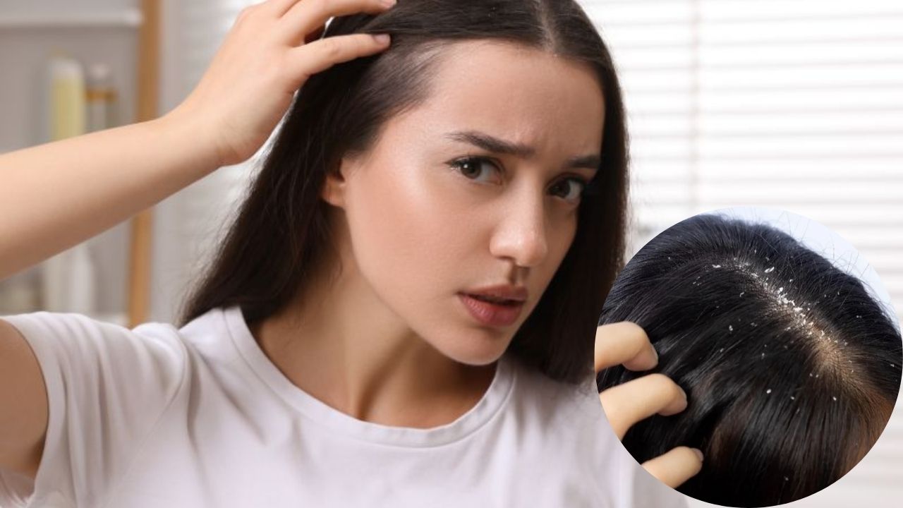 Hair Care Tips: कोंड्यापासून त्रस्त आहात? घरच्या घरी तयार करा अँटी-डँड्रफ शॅम्पू; केस होतील निरोगी