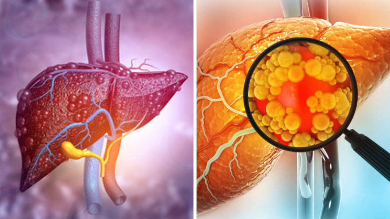 Fatty Liver: भारतात वाढतेय फॅटी लिव्हरचे प्रमाण; लठ्ठपणा आणि मधुमेहाशी थेट संबंध, तज्ज्ञांचा धक्कादायक इशारा