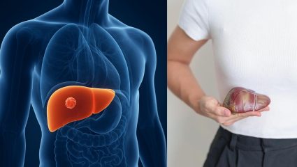 Liver Cancer: शरीरात ‘ही’ ५ लक्षणे दिसताच वेळीच व्हा सावध; असू शकतं लिव्हर कॅन्सरचं संकेत, अशी ओळखा लक्षणे
