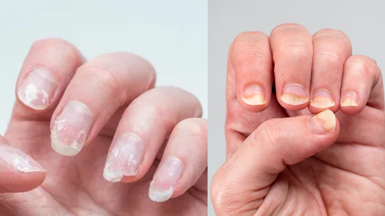 Nail Colour Meaning: नखांचा रंग बदलतोय? शरीर देतंय गंभीर आजारांचे संकेत; वेळेत ओळखा ‘ही’ लक्षणं