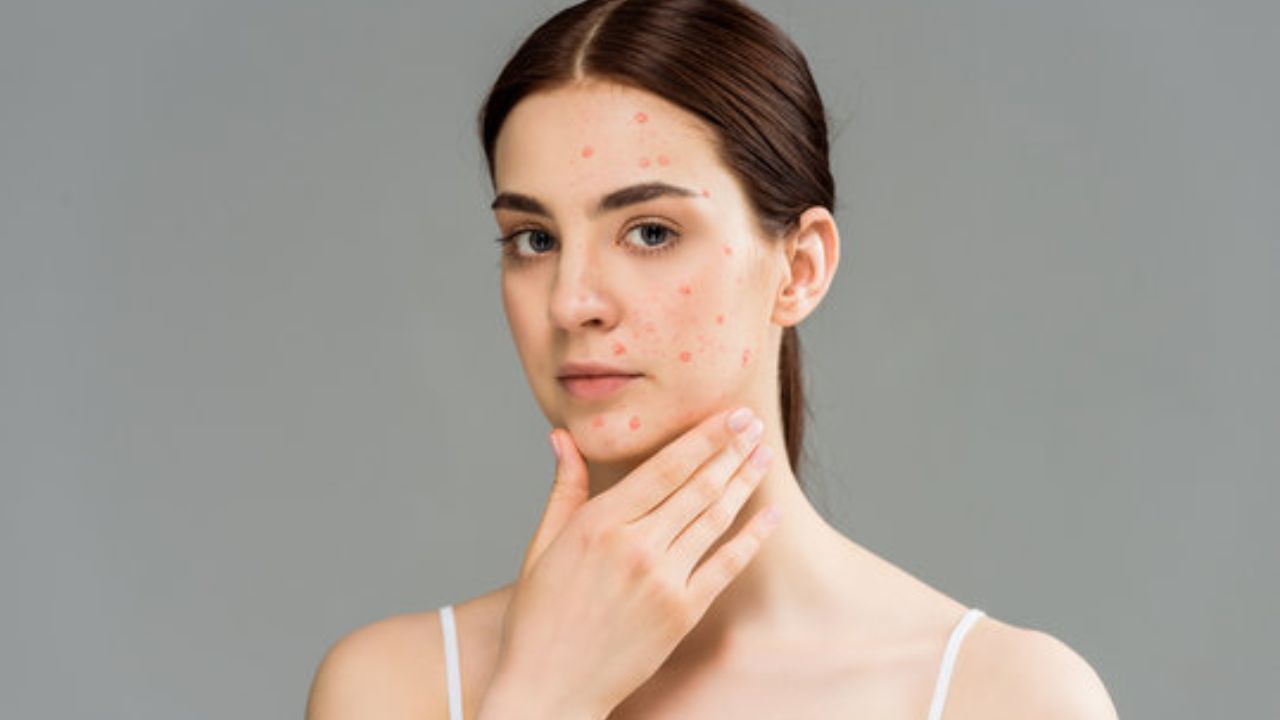 Skin Care Tips: चेहऱ्यावर सतत पिंपल्स येतात? फक्त तेलकट त्वचा नव्हे, ‘या’ सवयीही ठरू शकतात कारणीभूत