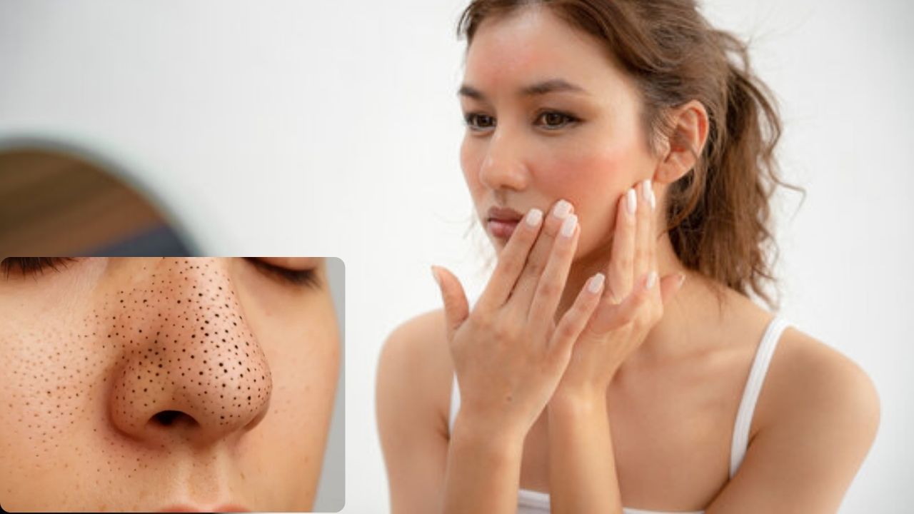 Blackheads Removal Tips: चेहऱ्यावरील हट्टी ब्लॅकहेड्सना करा बाय-बाय; ‘हे’ सोपे उपाय ठरतील फायदेशीर