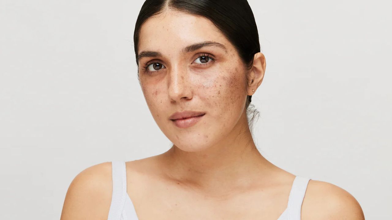 Skin Pigmentation: चेहऱ्यावरील पिग्मेंटेशनमुळे त्रस्त आहात? ‘हे’ घरगुती उपाय करा ट्राय, त्वचा उजळेल