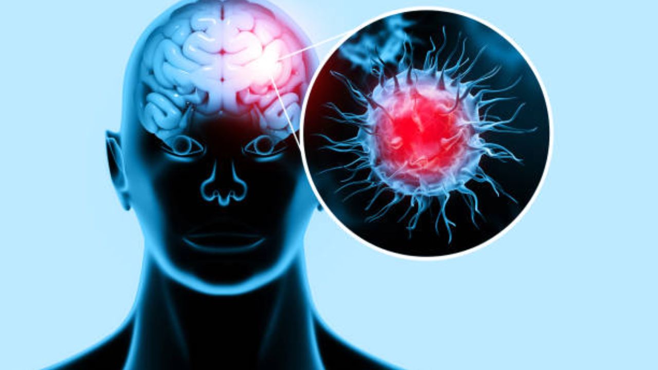 ग्लायोब्लास्टोमा म्हणजे काय? मेंदूच्या कर्करोगातील सर्वात आक्रमक प्रकार कोणता, उपचार करणे का ठरते मोठे आव्हान