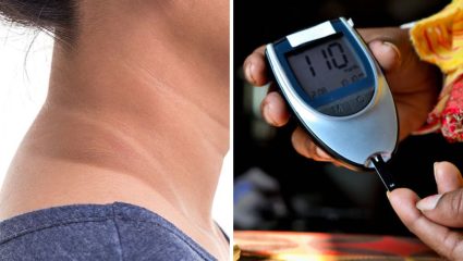 मान- काखेत काळेपणा वाढला आहे? टॅनिंग नसून आरोग्यासंबंधित असू शकतो ‘या’ गंभीर आजारांचा धोका, जाणून घ्या नैसर्गिक उपाय