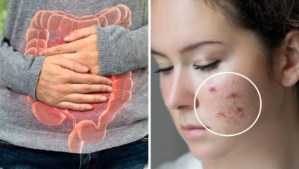 आतड्यांमध्ये सडलेल्या घाणीमुळे त्वचेवर पिंपल्स येतात? पोटाच्या तक्रारी कमी करण्यासाठी नियमित खा ‘हे’ पदार्थ, त्वचा होईल नितळदार