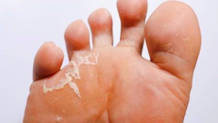 पायांना सतत खाज येते? नायट्यापासून कायमची सुटका मिळवण्यासाठी करून पहा ‘हे’ घरगुती उपाय, जळजळ होईल कमी