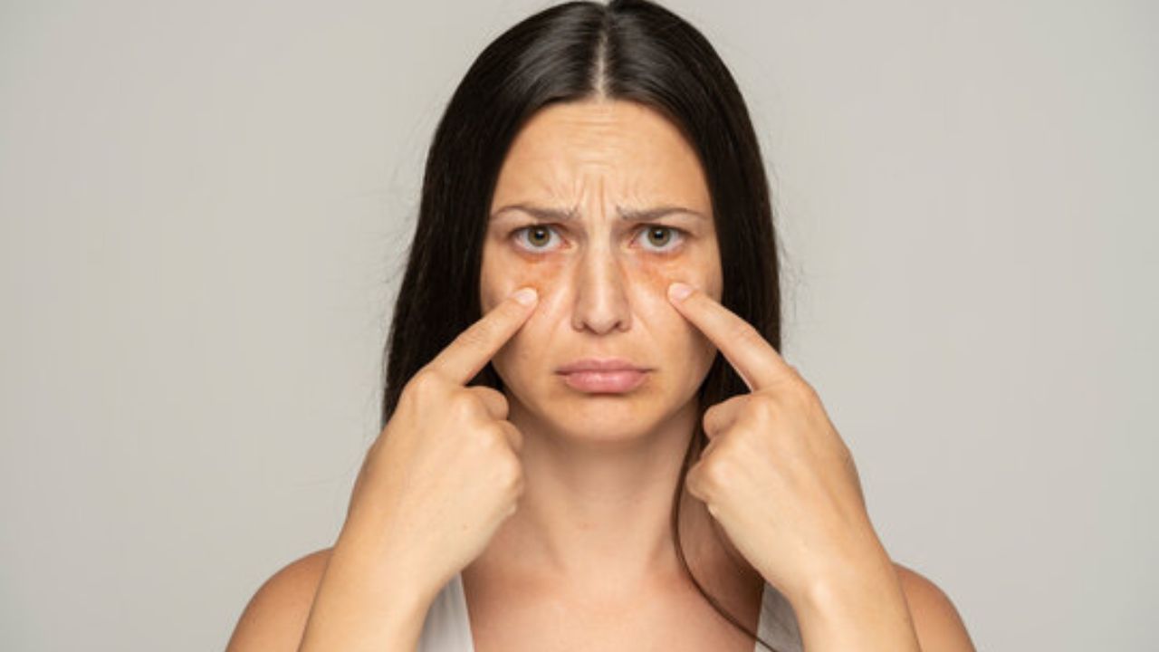 Dark Circles: ८ तास झोपूनही डोळ्यांखाली डार्क सर्कल्स? दुर्लक्ष करू नका; जाणून घ्या खरी कारणे