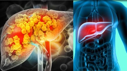 Fatty liver: फॅटी लिव्हरबाबत जनजागृतीसाठी जसलोक हॉस्पिटलचा पुढाकार; ‘लिव्हर फेस्ट सीझन 2’ चे आयोजन